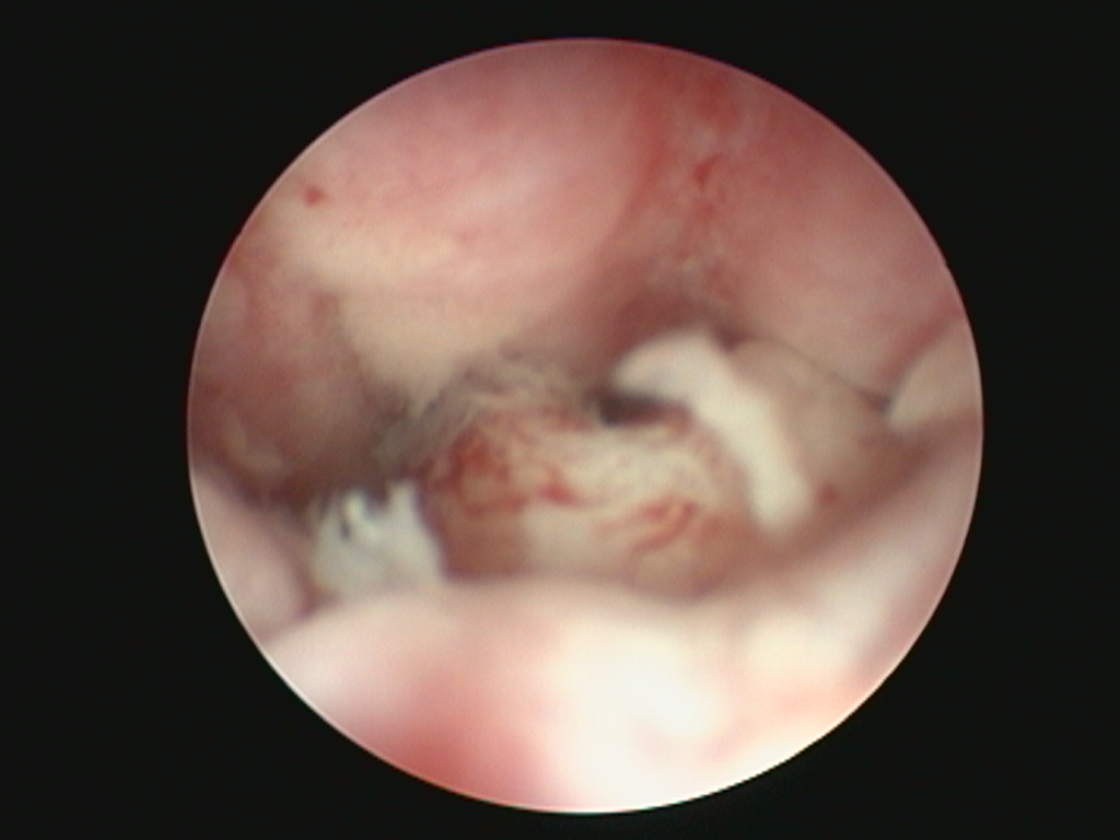 endoscopia